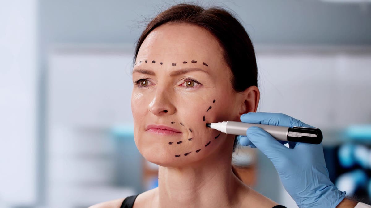 Facelift marks