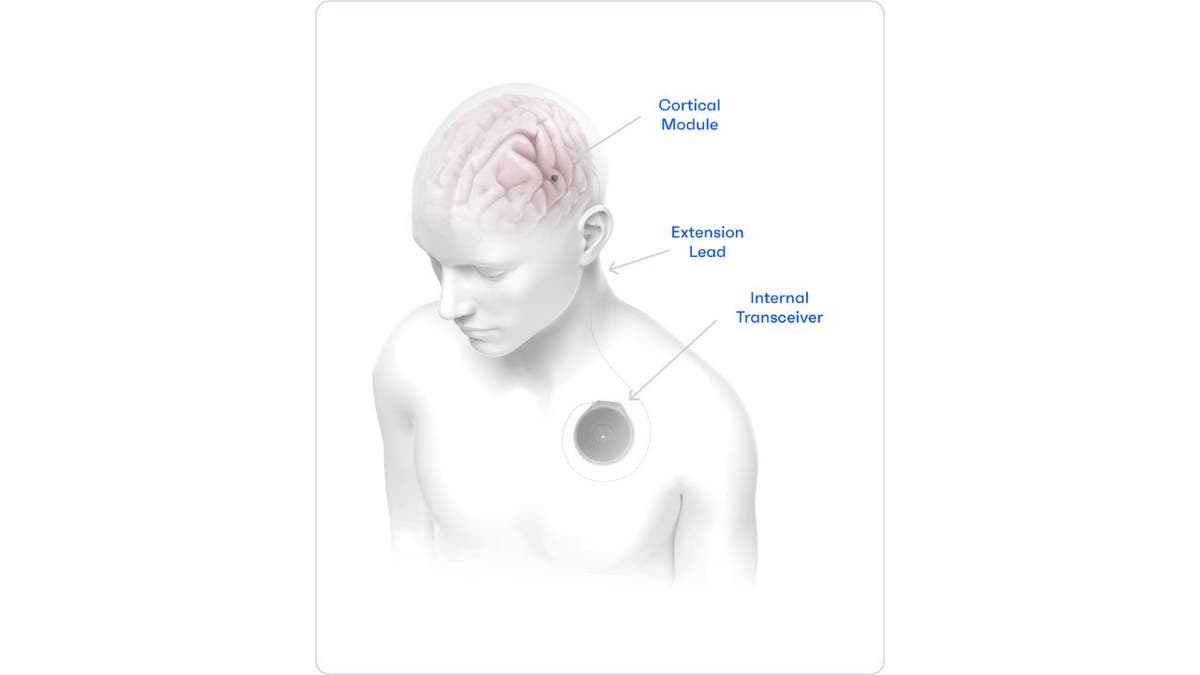 Implant Brain 7